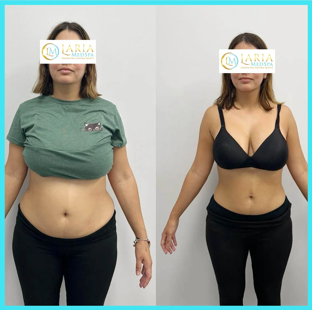 LARIA MedSpa body contouring before and after