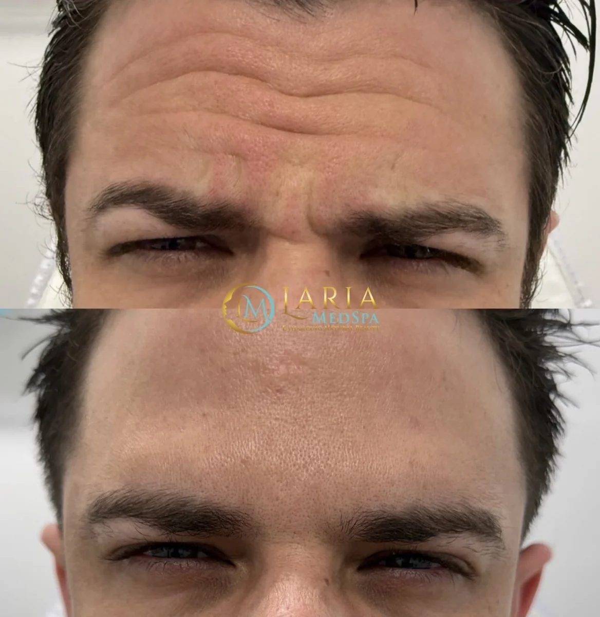 LARIA MedSpa facial rejuvenation before and after