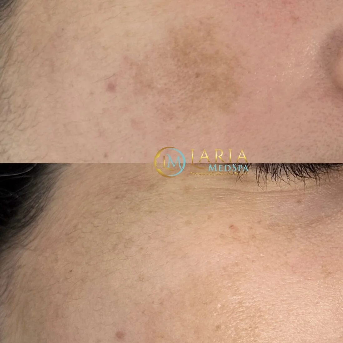 LARIA MedSpa pigmented lesions before and after